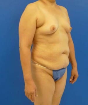 Tummy Tuck before, case 1122, angle view