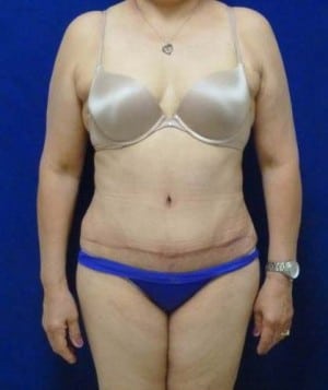 Tummy Tuck after, case 1122, front view
