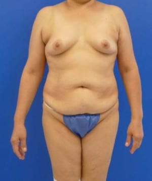 Tummy Tuck before, case 1122, front view