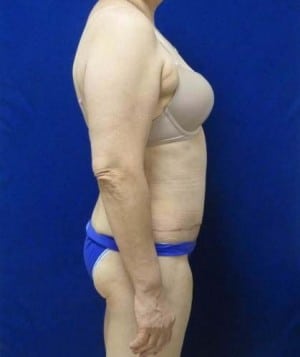 Tummy Tuck after, case 1122, side view