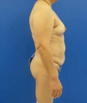 Tummy Tuck before, case 1122, side view