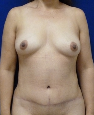 Tummy Tuck after, case 1117, front view