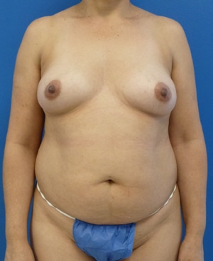 Tummy Tuck before, case 1117, front view