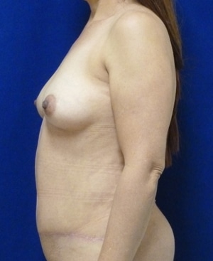 Tummy Tuck after, case 1117, side view