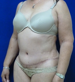 Tummy Tuck after, case 1114, angle view