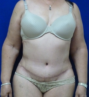 Tummy Tuck after, case 1114, front view