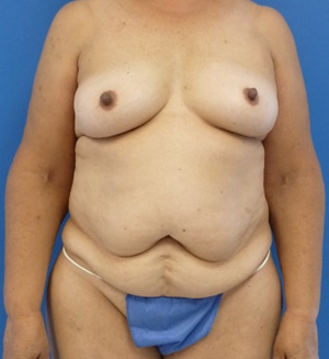 Tummy Tuck before, case 1114, front view