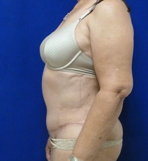 Tummy Tuck after, case 1114, side view