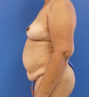 Tummy Tuck before, case 1114, side view