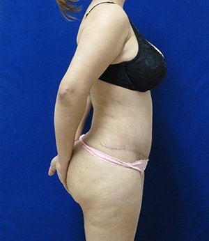 Tummy Tuck after, case 1113, side view