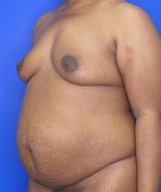 Tummy Tuck before, case 1154, angle view
