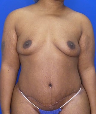 Tummy Tuck after, case 1154, front view