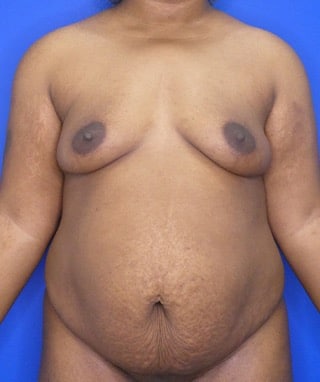 Tummy Tuck before, case 1154, front view
