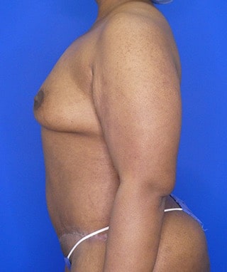 Tummy Tuck after, case 1154, side view