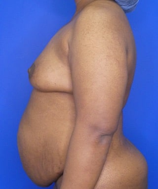 Tummy Tuck before, case 1154, side view