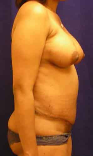Tummy Tuck after, case 1109, side view