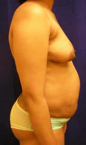 Tummy Tuck before, case 1109, side view