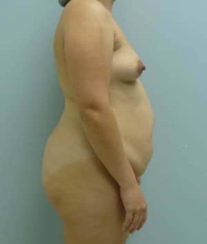 Tummy Tuck before, case 1107, side view