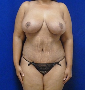 Tummy Tuck after, case 1103, front view