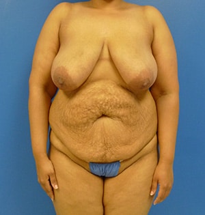 Tummy Tuck before, case 1103, front view