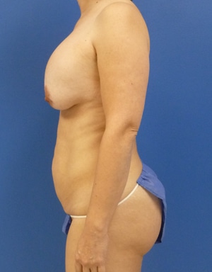 Tummy Tuck before, case 1100, side view