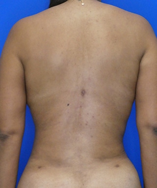 Tummy Tuck after, case 1096, back view