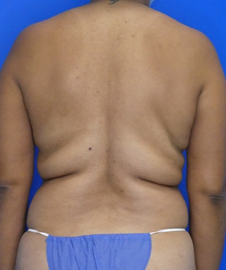 Tummy Tuck before, case 1096, back view