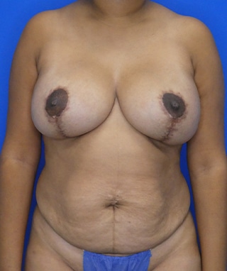 Tummy Tuck before, case 1096, front view