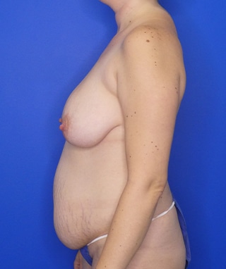 Tummy Tuck before, case 1152, side view