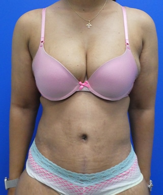 Tummy Tuck after, case 1151, front view