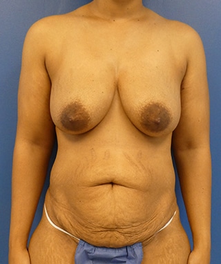 Tummy Tuck before, case 1151, front view