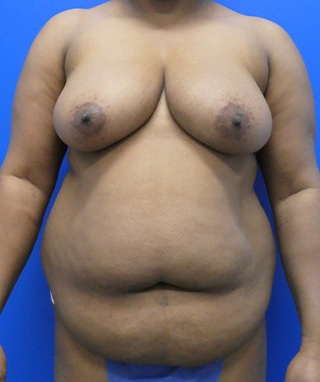 Tummy Tuck before, case 1150, front view