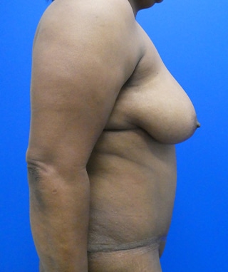Tummy Tuck after, case 1150, side view