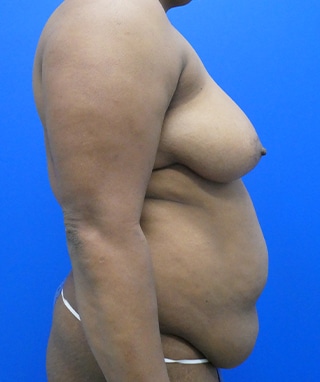 Tummy Tuck before, case 1150, side view