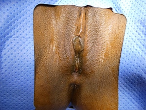 vaginoplasty13-after