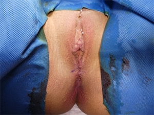 vaginoplasty-patient-16-after
