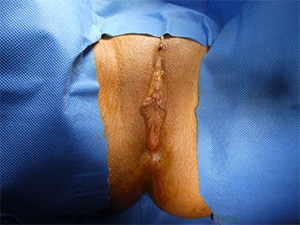 vaginoplasty-patient-16-before