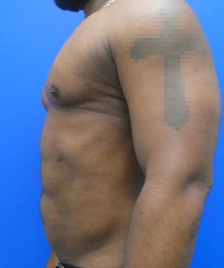 Vaser Lipo Etching after, case 1204, side view