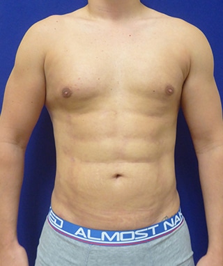 Vaser Lipo Etching after, case 1203, front view