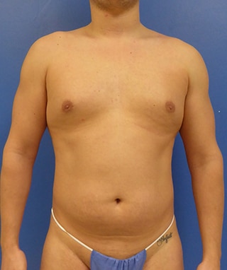 Vaser Lipo Etching before, case 1203, front view