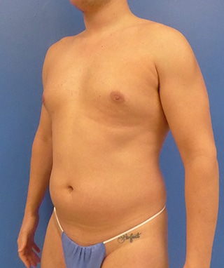 Vaser Lipo Etching before, case 1203, oblique view