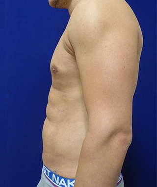 Vaser Lipo Etching after, case 1203, side view