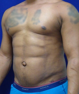 Vaser Lipo Etching after, case 1202, angle view